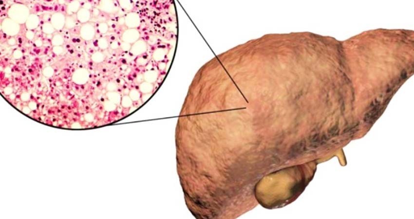 Advierten: 50% de mexicanos podría tener hígado graso