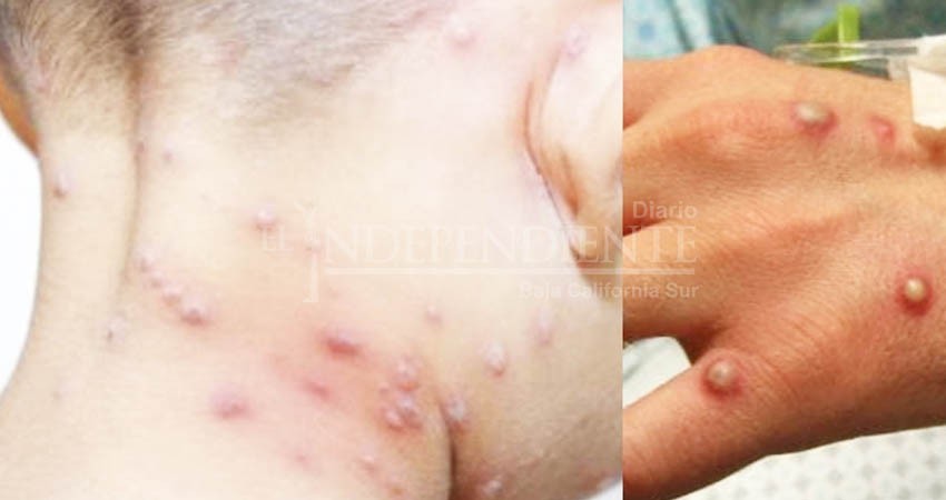 Preparada BCS para diagnosticar posibles casos de viruela del mono