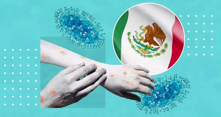 Viruela del mono: Estos estados han reportado casos en México
