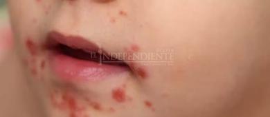 Registra Secretaria de Salud 50 casos positivos a coxsackie en Los Cabos