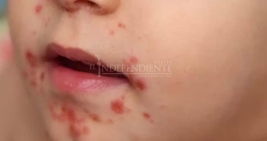 Registra Secretaria de Salud 50 casos positivos a coxsackie en Los Cabos
