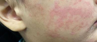 Registra BCS siete casos activos de sarampión en lo que va del año