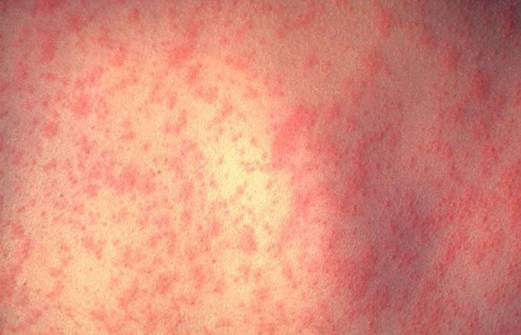 En EU el primer muerto de sarampión en más de 10 años