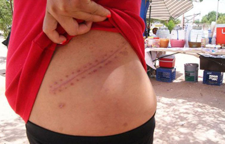 Dona riñón y lo pierde el hospital