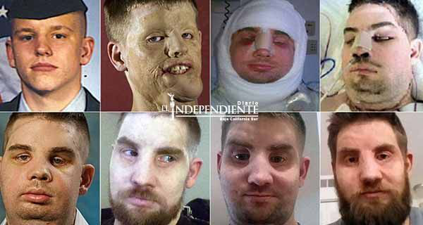 Soldado recibe trasplante de rostro, hoy comparte su historia Soldado recibe trasplante de rostro, hoy comparte su historia
