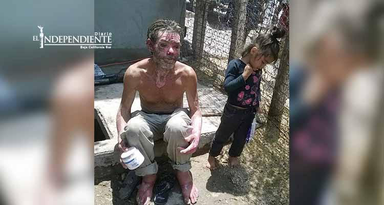 Piden ayuda para Cabeño que sufrió fuertes quemaduras al explotarle un mofle