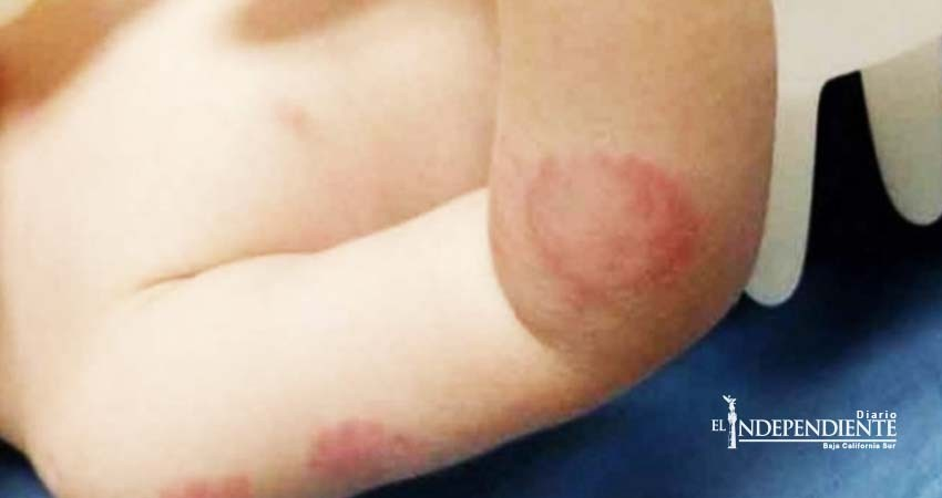 Notifican de suspensión a guardería donde bebé fue mordido 25 veces