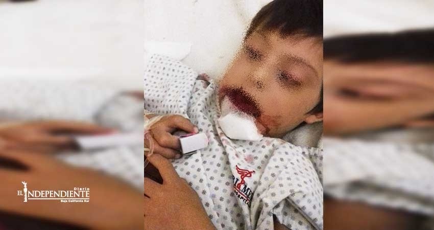 Salvatierra tardará 20 días en atender a niño Down con mandíbula fracturada Salvatierra tardará 20 días en atender a niño Down con mandíbula fracturada