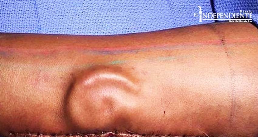 Cirujanos 'crecen' oreja en brazo de mujer soldado en EU Cirujanos 'crecen' oreja en brazo de mujer soldado en EU