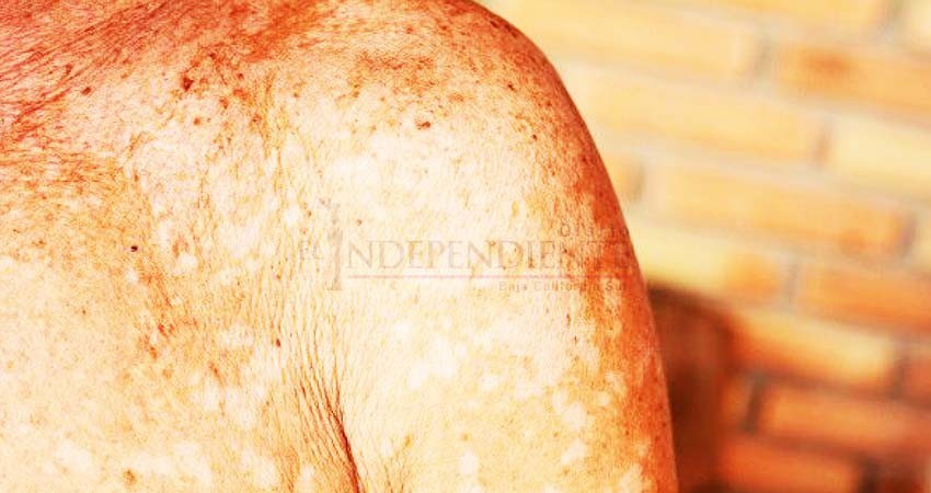 Exhortan médicos a tomar medidas para prevenir hongos en la piel por calor