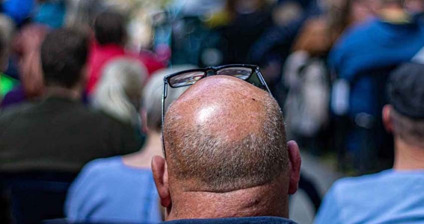 Calvicie estaría relacionada con casos graves de covid, según estudio Calvicie estaría relacionada con casos graves de covid, según estudio