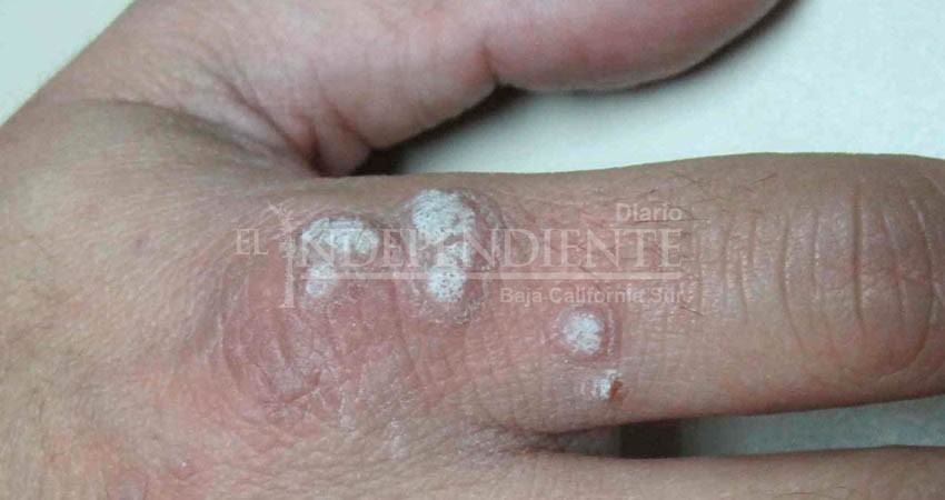 IMSS hace un llamado a la población para prevenir y detectar a tiempo el VPH IMSS hace un llamado a la población para prevenir y detectar a tiempo el VPH