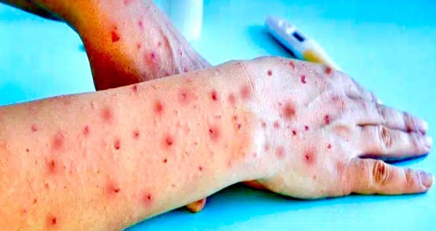 Registra BCS su primer caso de Viruela del Mono