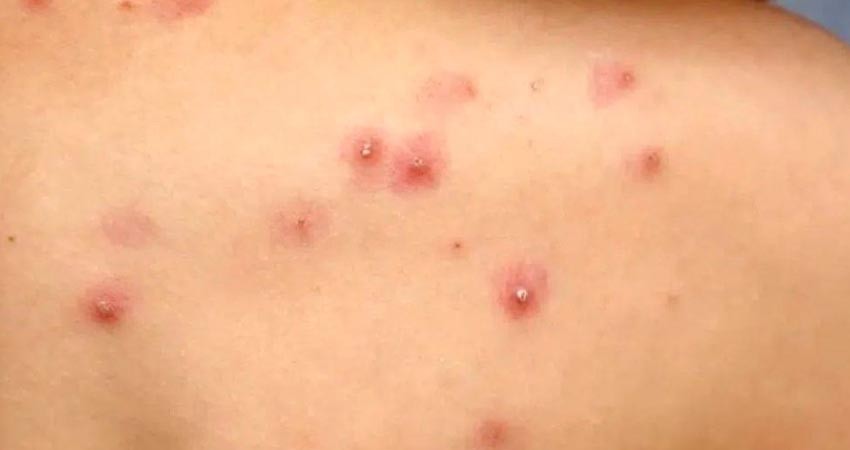 Confirman 6 casos sospechosos de viruela símica en BCS