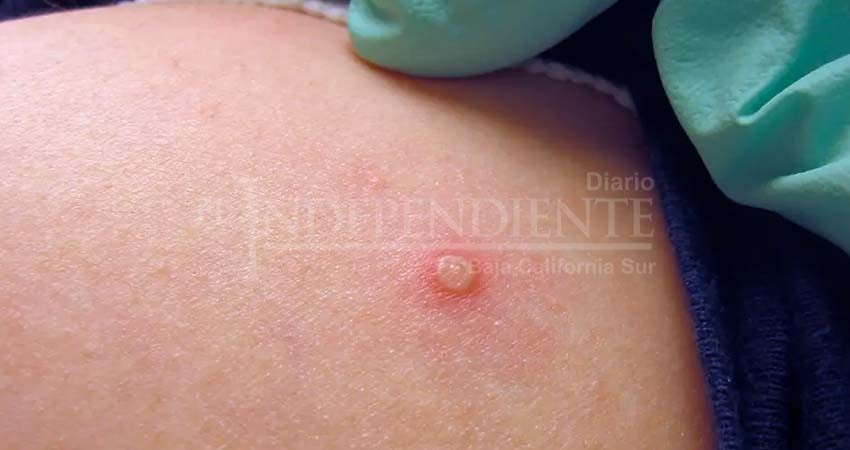 Reporta BCS 4 nuevos casos sospechosos de viruela símica Reporta BCS 4 nuevos casos sospechosos de viruela símica