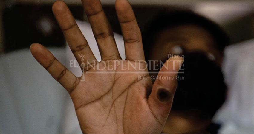 De 16 casos sospechosos de viruela símica, 15 han sido descartados: SSA