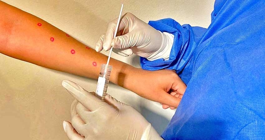Análisis de laboratorio confirma caso de viruela símica en BCS Análisis de laboratorio confirma caso de viruela símica en BCS