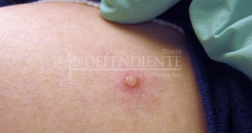 Confirma SSA un nuevo caso de viruela símica en La Paz Confirma SSA un nuevo caso de viruela símica en La Paz