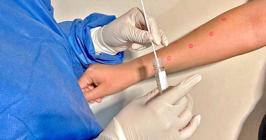 Registra La Paz un nuevo caso de “viruela del mono”