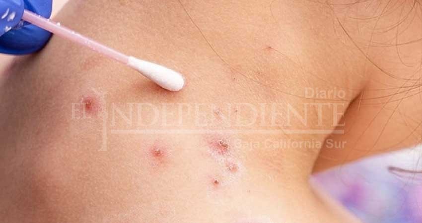 Se han presentado 6 casos de viruela símica en BCS