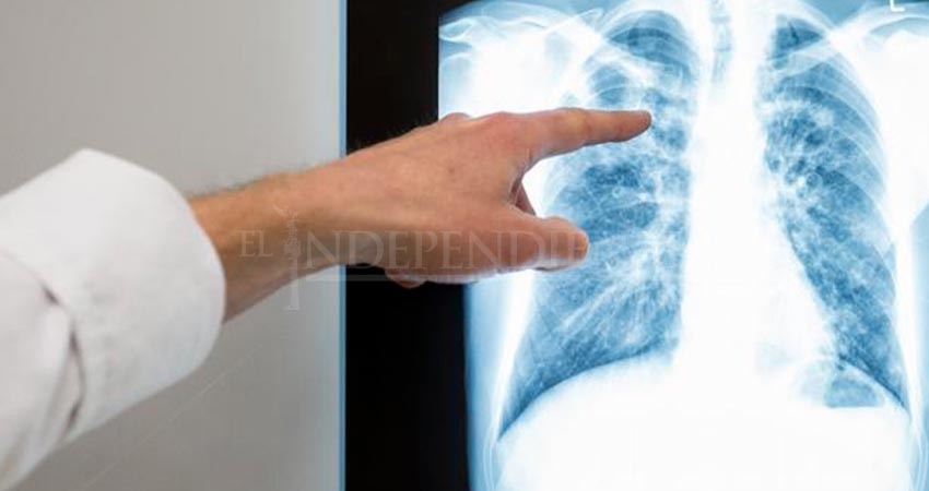 Se han registrado 44 casos de tuberculosis en BCS Se han registrado 44 casos de tuberculosis en BCS