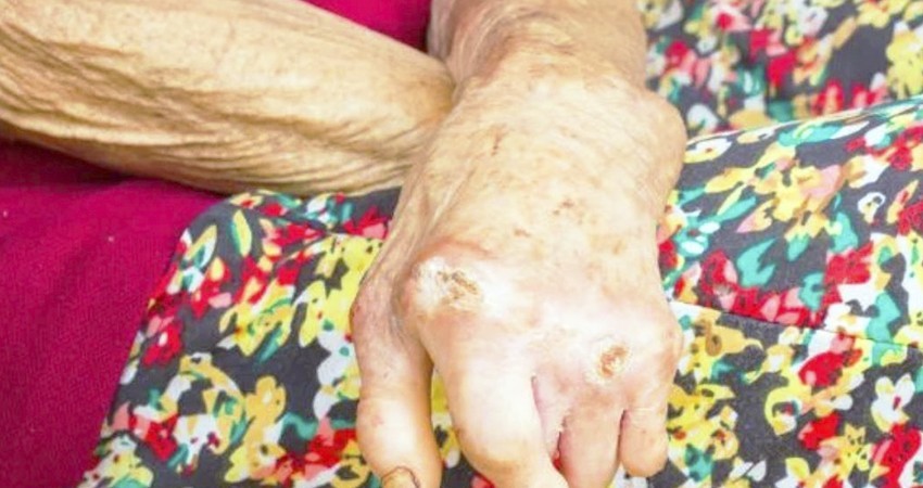 Existen en el pais 12 municipios catalogados como prioritarios por casos de lepra