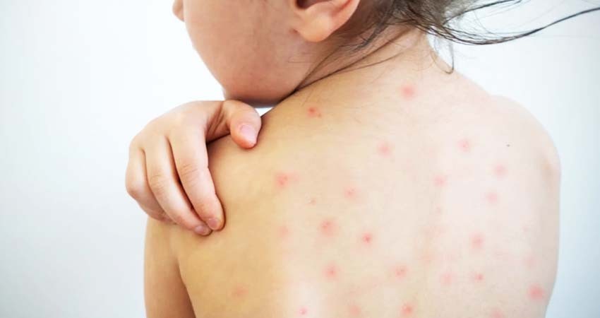 México Suma 4 Casos de Sarampión Asociados a Contagio de Importación