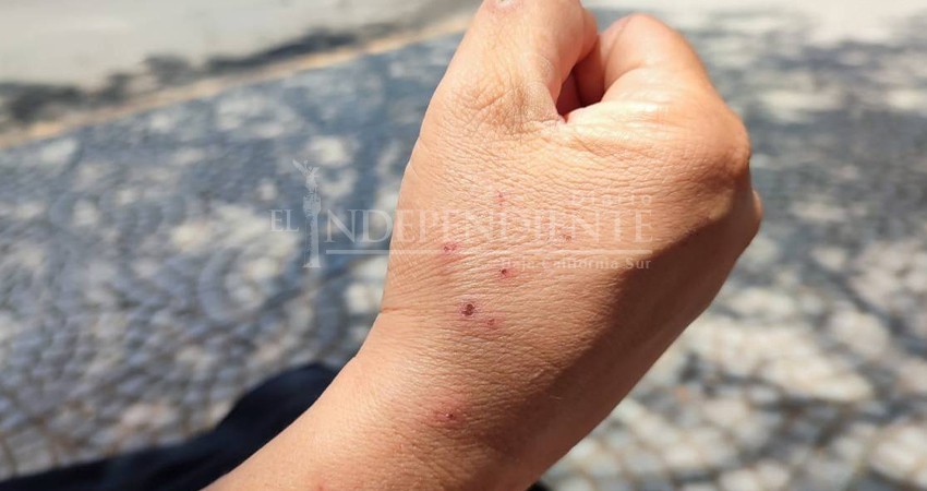 Registra Baja California Sur 18 casos de viruela del mono en lo que va del 2024