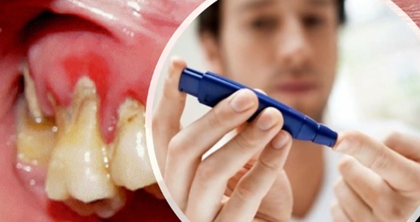 Autoridad en salud llama a las personas con diabetes llevar una buena salud bucal