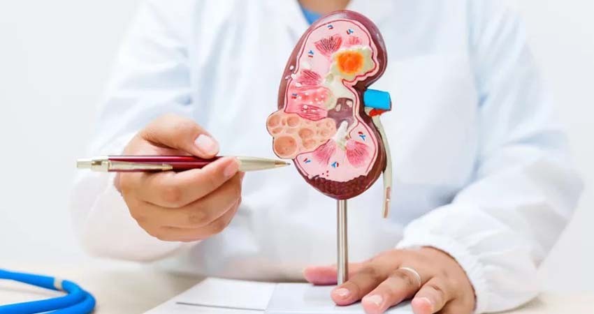 Bajo consumo de agua en la población aumenta riesgo de padecer cálculos renales Bajo consumo de agua en la población aumenta riesgo de padecer cálculos renales