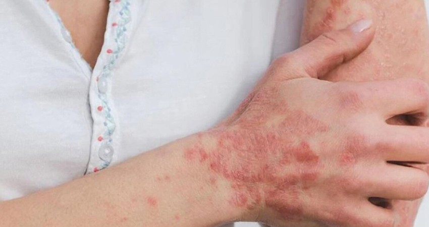 Se disparan casos de viruela del mono en México; suman 174