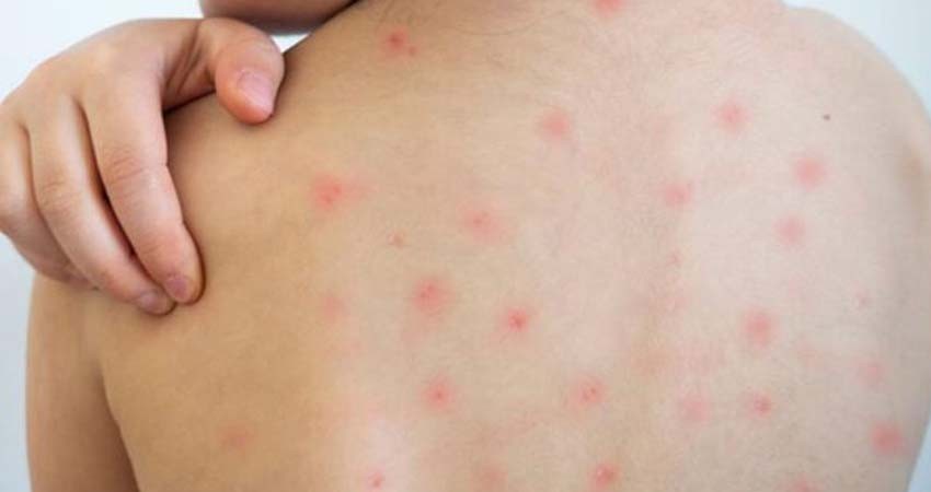 México reporta cuatro muertes por sarampión y mil 629 contagios en 2025