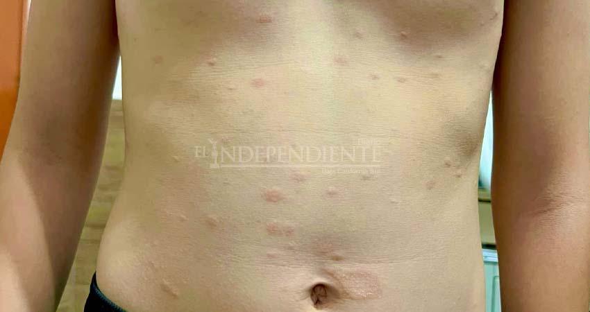 Confirman los primeros 3 casos de sarampión en BCS Confirman los primeros 3 casos de sarampión en BCS