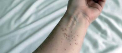 México en riesgo de perder certificado contra sarampión; BCS registró 8 casos