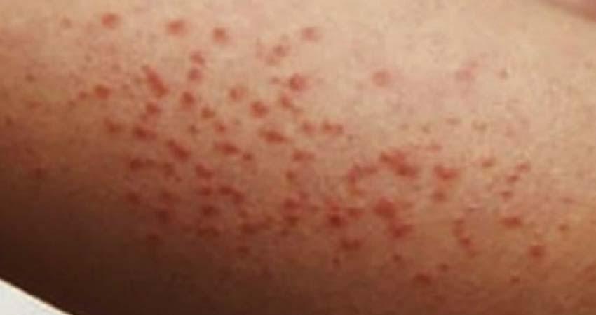 Sarampión se expande por todo México; piden vacunarse