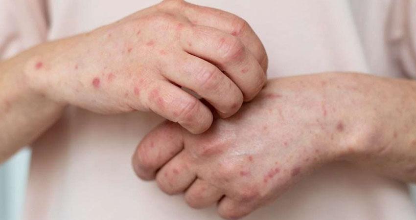 Sarampión en México: Salud confirma la primera muerte en 2026