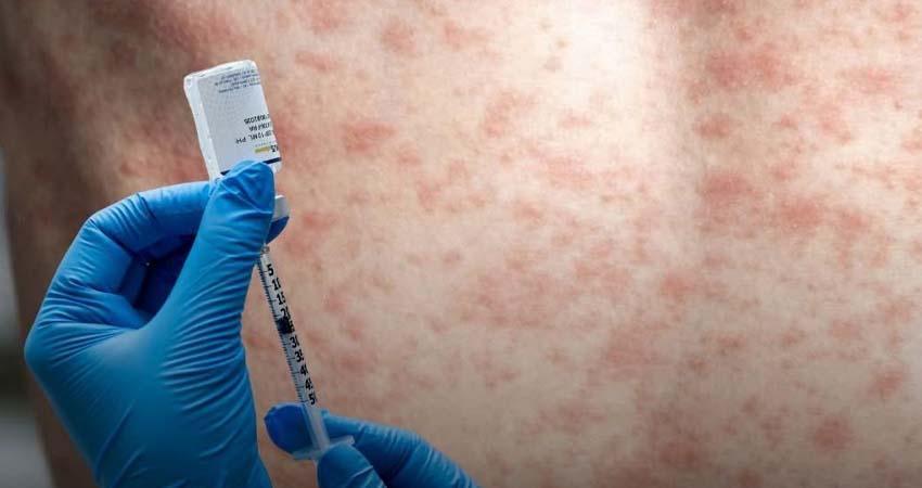 Confirman segundo contagio de sarampión en CSL