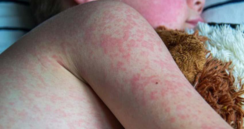 Dos nuevas muertes por sarampión elevan a 33 los decesos por brote en México