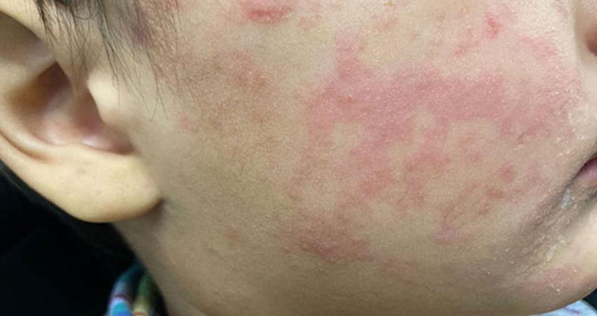 Registra BCS siete casos activos de sarampión en lo que va del año