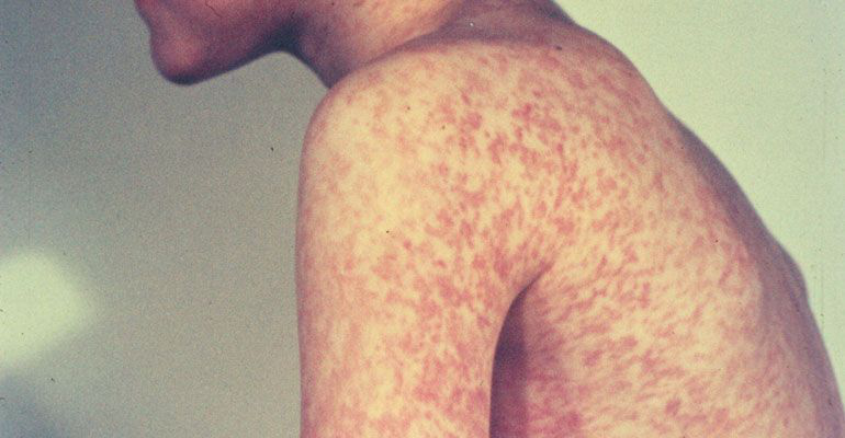 Extiende Ssa alerta por virus de sarampión en EU