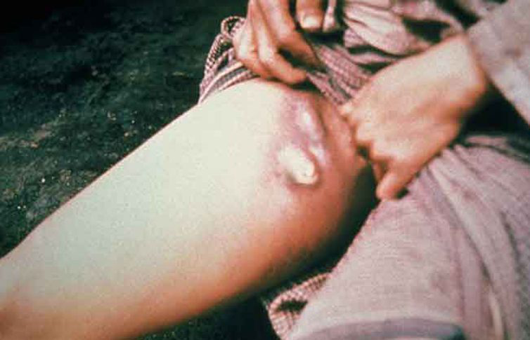 Muere adolescente por peste en Colorado