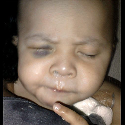 Dan prisión a médico por extirpar ojo sano a bebé; sale libre con fianza