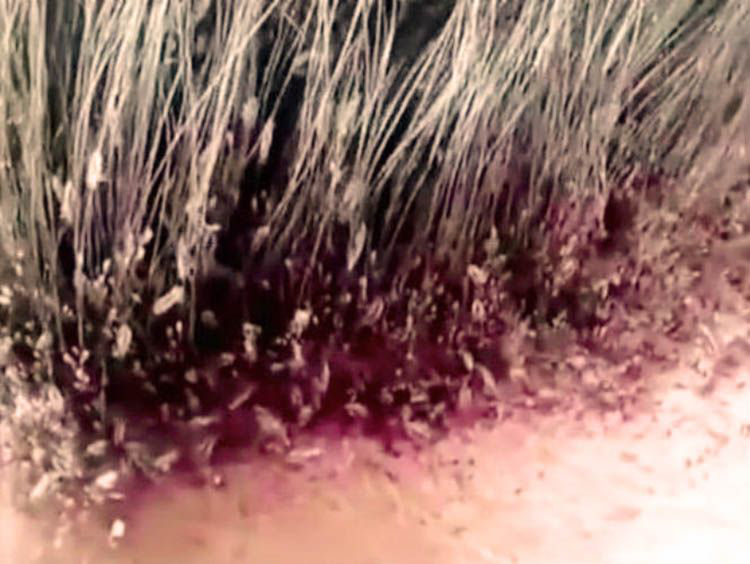 VIDEO: La peor infestación de piojos que has visto jamás