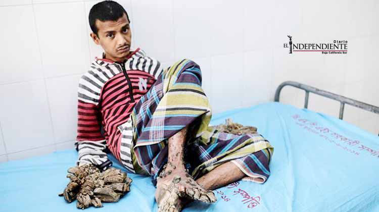 'Hombre árbol' ya podría ser operado en hospital de Bangladesh