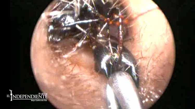 NIDO DE HORMIDAS EN EL OÍDO  EN UNA NIÑA