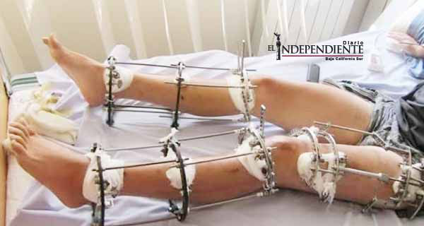 La escabrosa cirugía para ser más altos