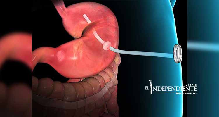 Aprueban en EU dispositivo para bajar de peso