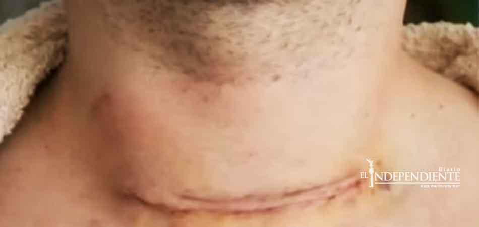 Cáncer de tiroides... ¿Cuáles son sus causas y síntomas?