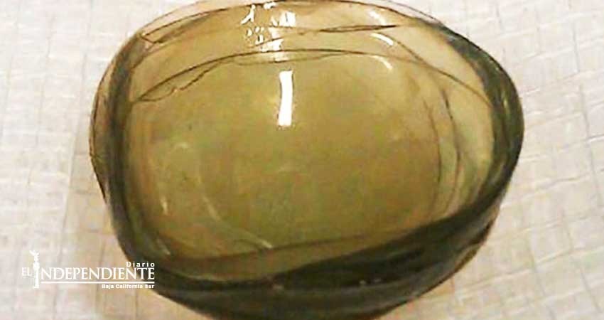 Creyó padecer cataratas pero tenía 27 lentes de contacto pegados