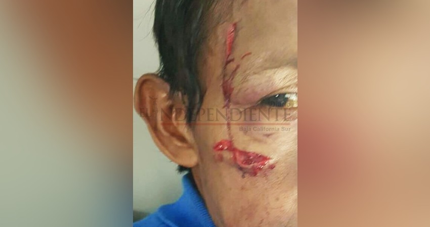 Se registra otro brutal ataque de perro en Los Cabos